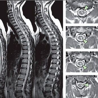 Diagnostic d'une ostéochondose thoracique
