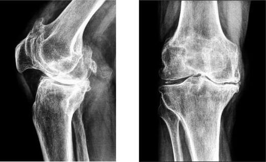 Gonarthrose de l'articulation du genou à la radiographie