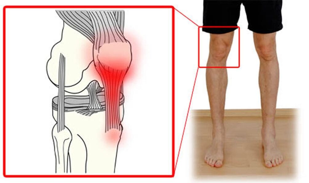Tendinite – Inflammation des tendons de l'articulation du genou