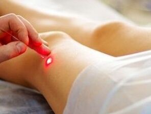 Traitement de l'arthrose de l'articulation du genou avec un laser